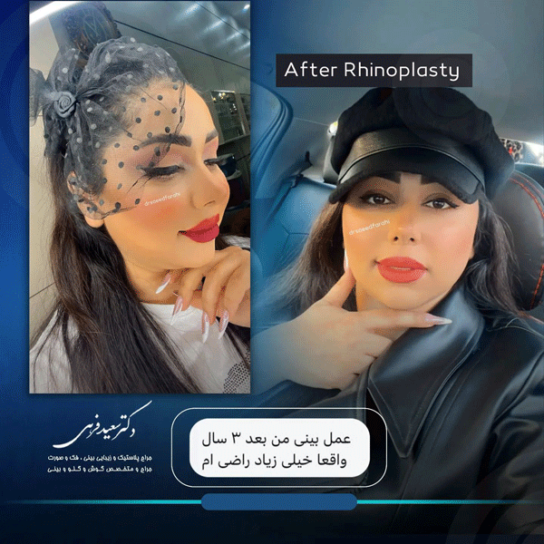 عکس جراحی بینی در بابل