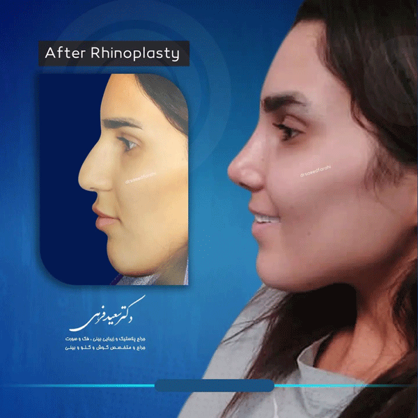 عکس قبل و بعد جراحی بینی در بابل