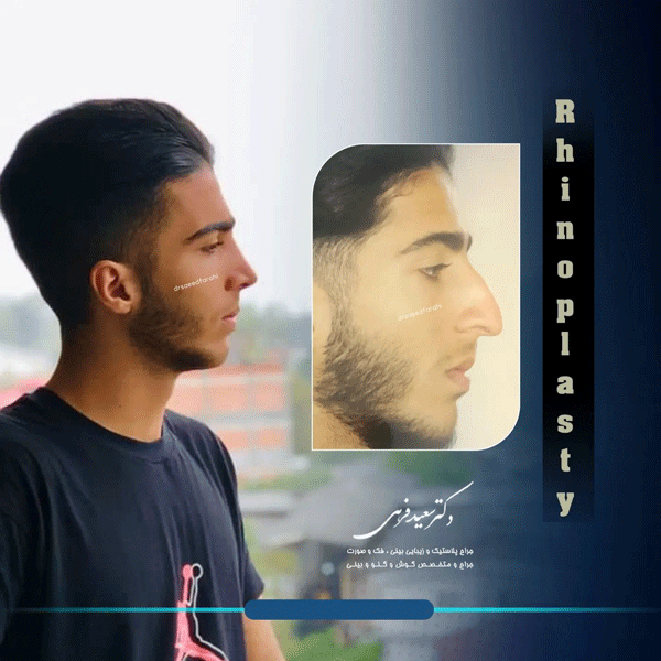 عکس قبل و بعد جراحی بینی