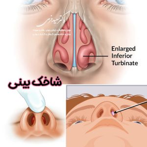 شاخک های بینی - دکتر سعید فرهی