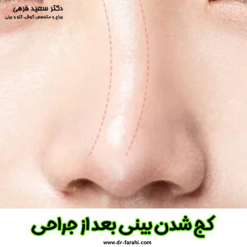 کج شدن بینی بعد عمل جراحی - دکتر سعید فرهی
