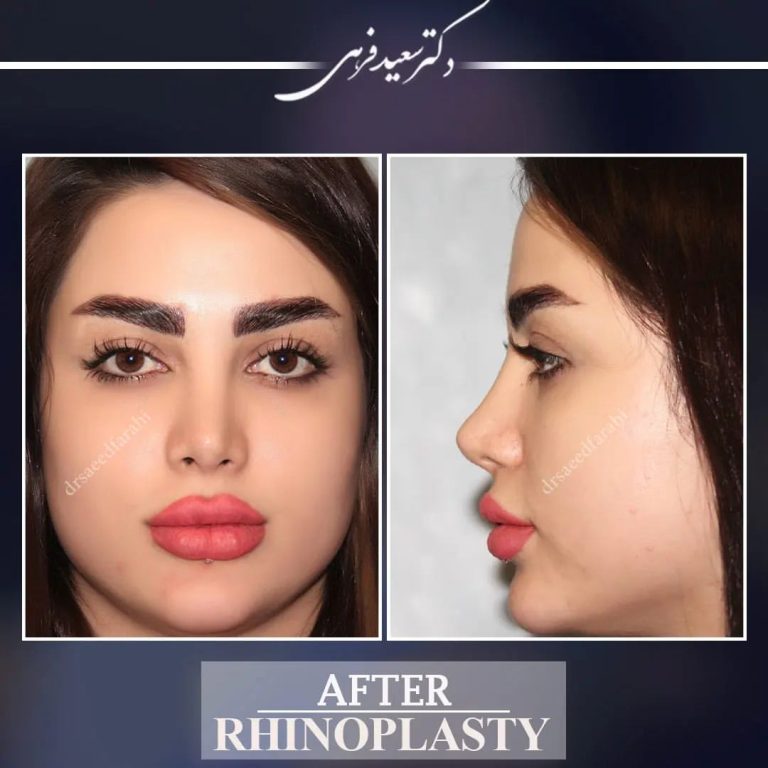 جراحی بینی استخوانی - دکتر سعید فرهی