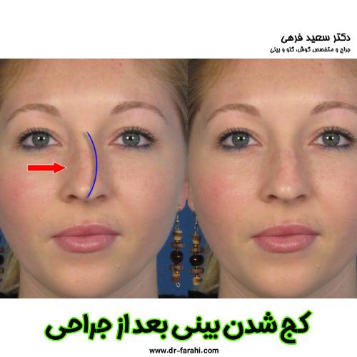 کج شدن بینی بعد از جراحی - دکتر سعید فرهی