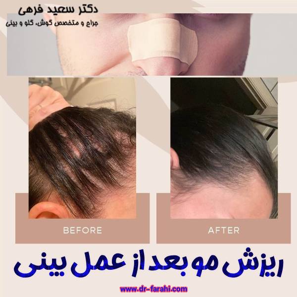 ریزش مو بعد عمل بینی