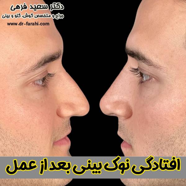افتادگی نوک بینی بعد عمل - دکتر سعید فرهی