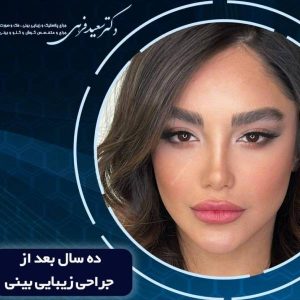 عکس جراحی بینی در بابل - دکتر سعید فرهی