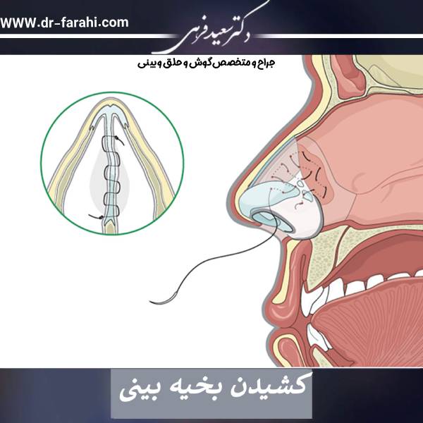 کشیدن بخیه بینی - دکتر سعید فرهی