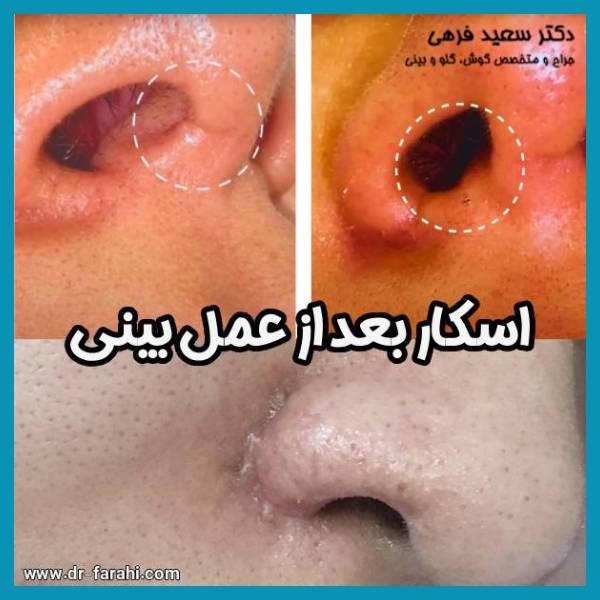 اسکار بعد از عمل بینی