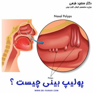 پولیپ بینی - دکتر سعید فرهی