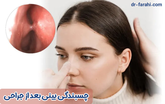 چسبندگی بینی بعد از جراحی