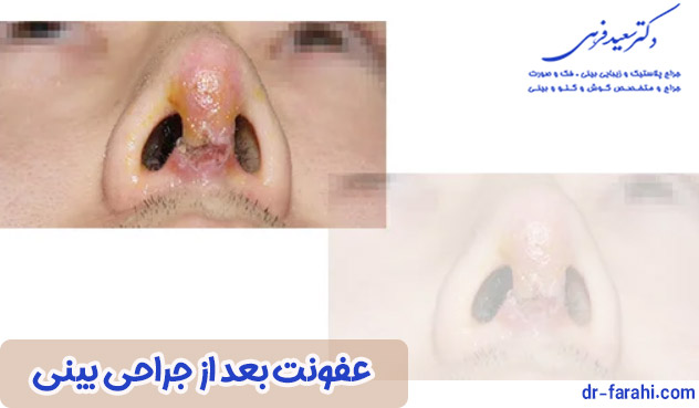 عفونت بعد از جراحی بینی