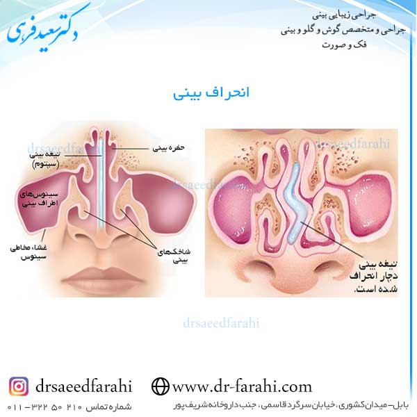 انحراف بینی