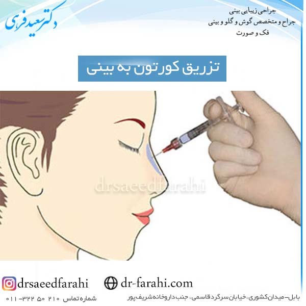 تزریق کورتون به بینی