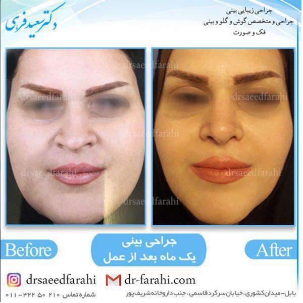 جراحی پلاستیک بینی در بابل - نمونه کار دکتر سعید فرهی