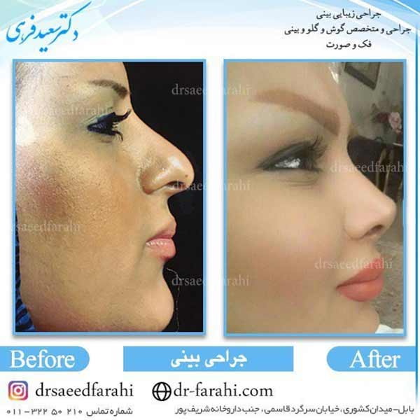 جراحی بینی فانتزی