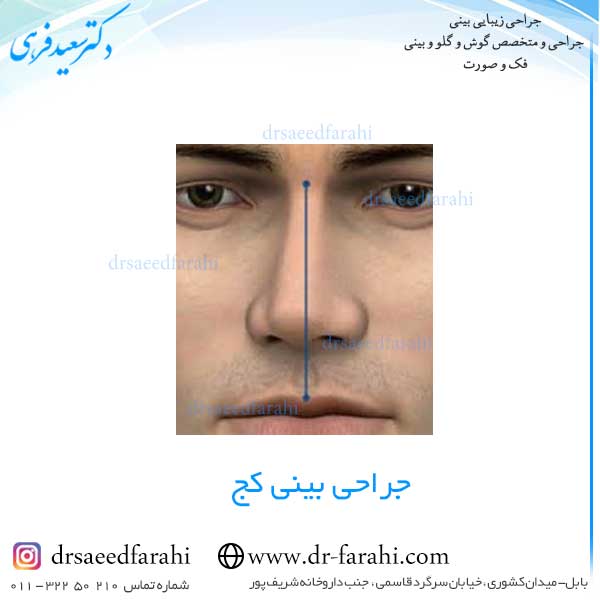 جراحی بینی کج