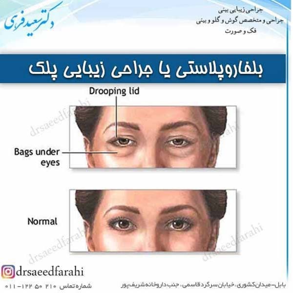 جراحی پلک