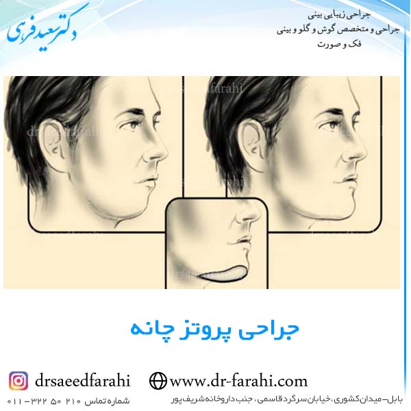 جراحی پروتز چانه