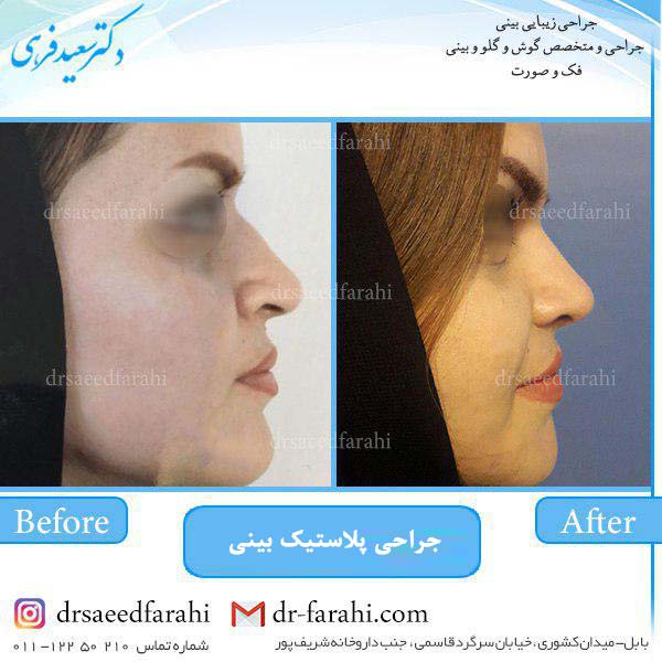 جراحی پلاستیک بینی