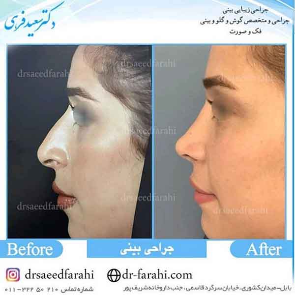 عمل جراحی بینی