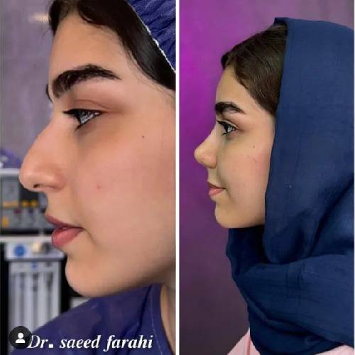 جراحی-بینی-در-بابل-174