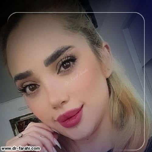 جراحی-بینی-در-بابل-176