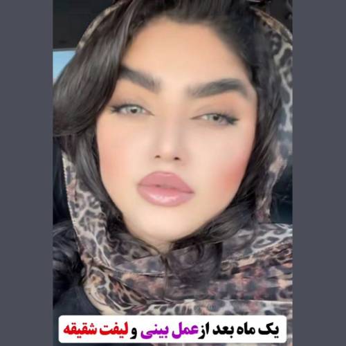 جراحی-بینی-در-بابل-179 (1)